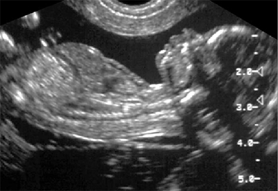 УЗИ-снимок беременной женщины