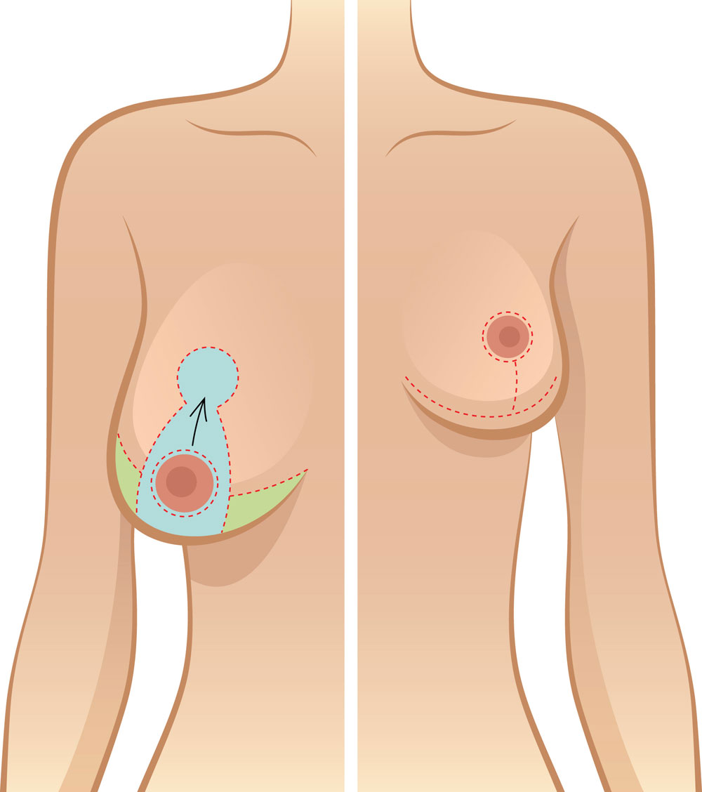 Anchor type scar pattern for breast reduction surgery