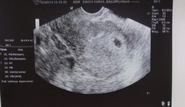 Узи на ранних сроках беременности фото 4 недели беременности