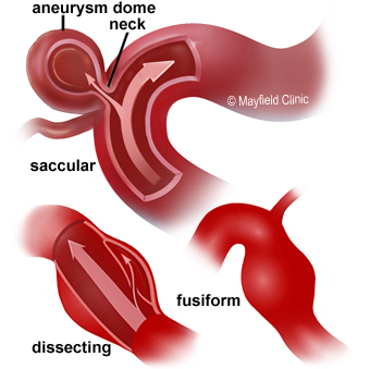 types of aneurysm