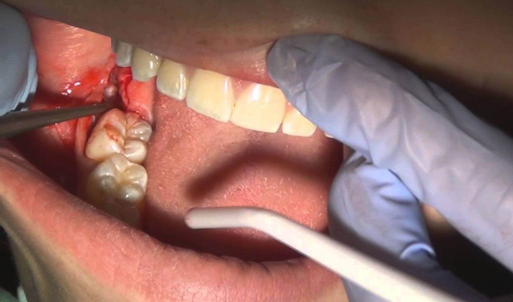 Ретенция зуба - зуб в десне, что делать