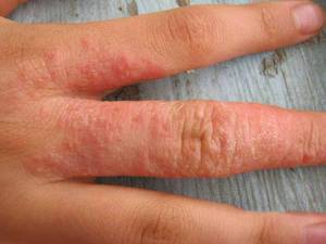 Аллергия на пальцах - это следствие работы с какими-то активными веществами и аллергенами.