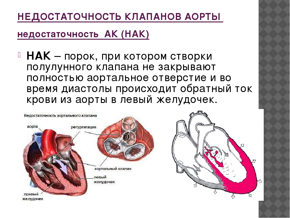 Порок аортального клапана мкб