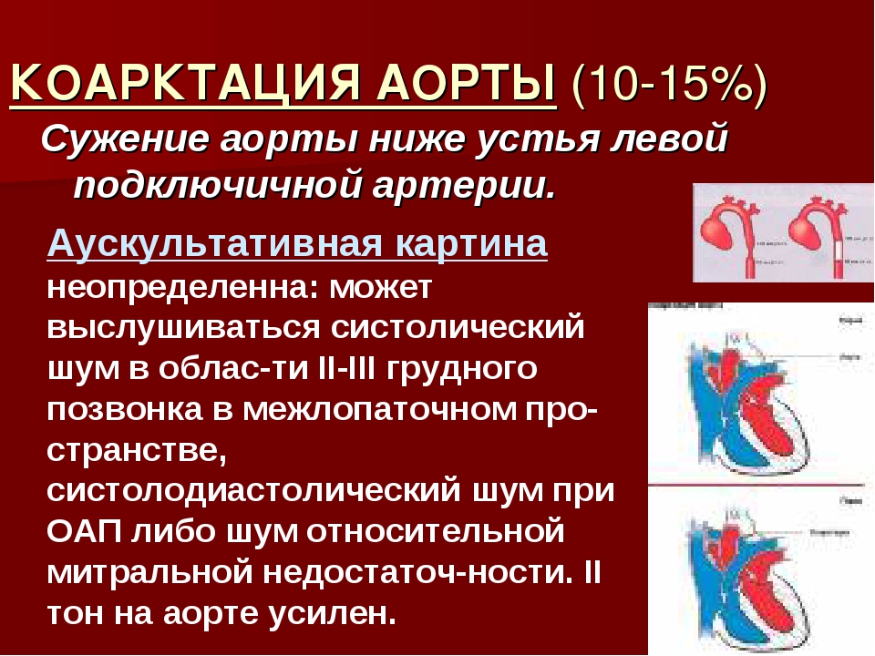 Аорта сердца уплотнена что это. Коарктация аорты это локализованное сужение. Коарктация аорты клинические проявления. Коарктация аорты Оперативная хирургия. Укажите ведущий симптом коарктации аорты.