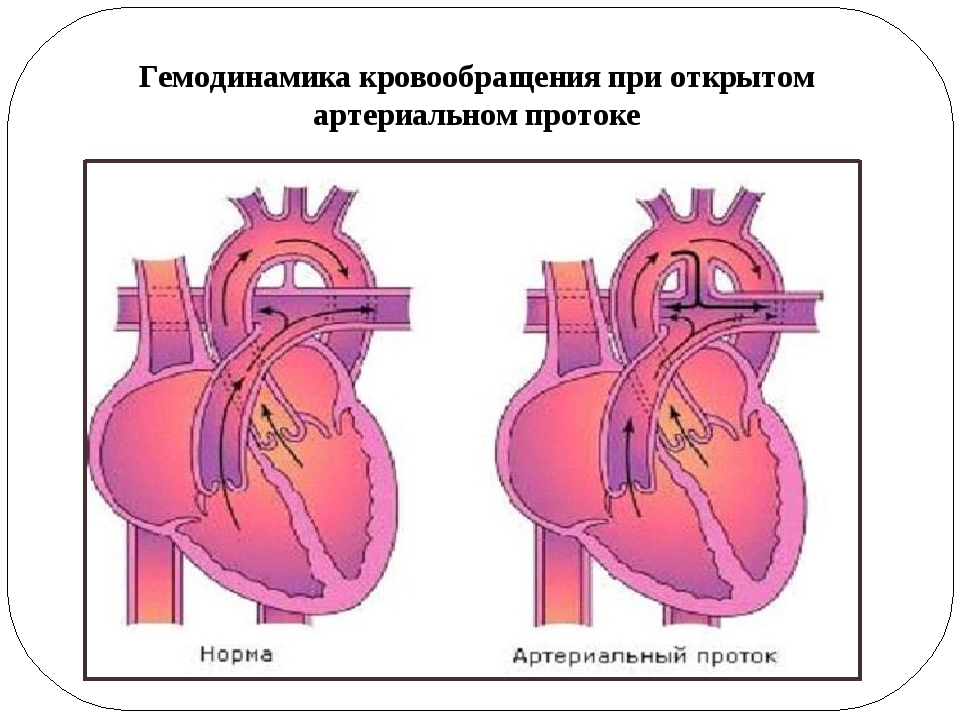 Схема открытого артериального протока