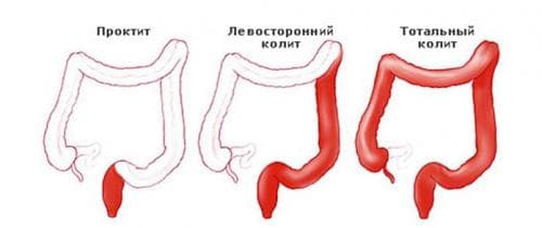 как лечить колит у беременных