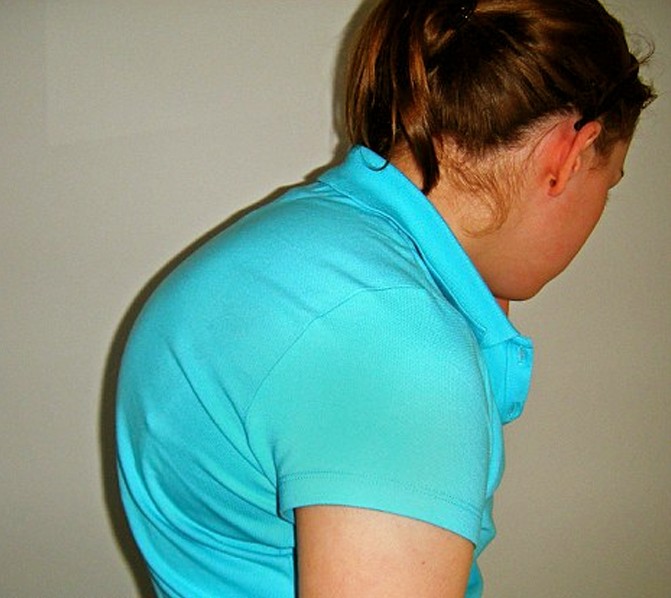 kyphosis pictures 2