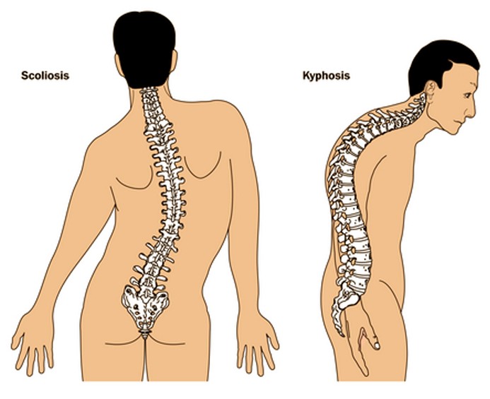 kyphosis pictures