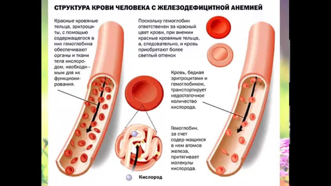 Анемия картинки для презентации