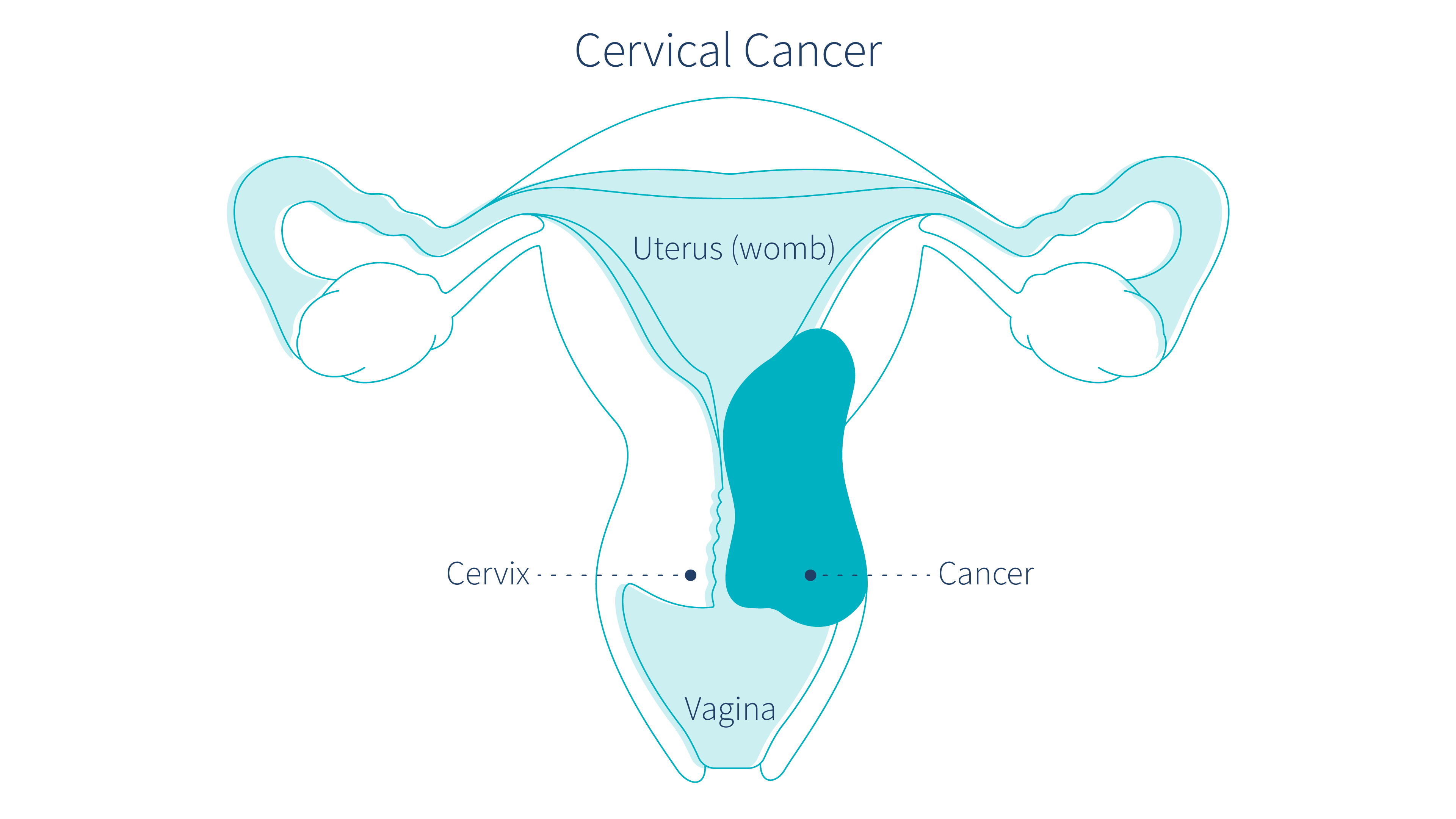 cervical-cancer-could-be-causing-brown-discharge