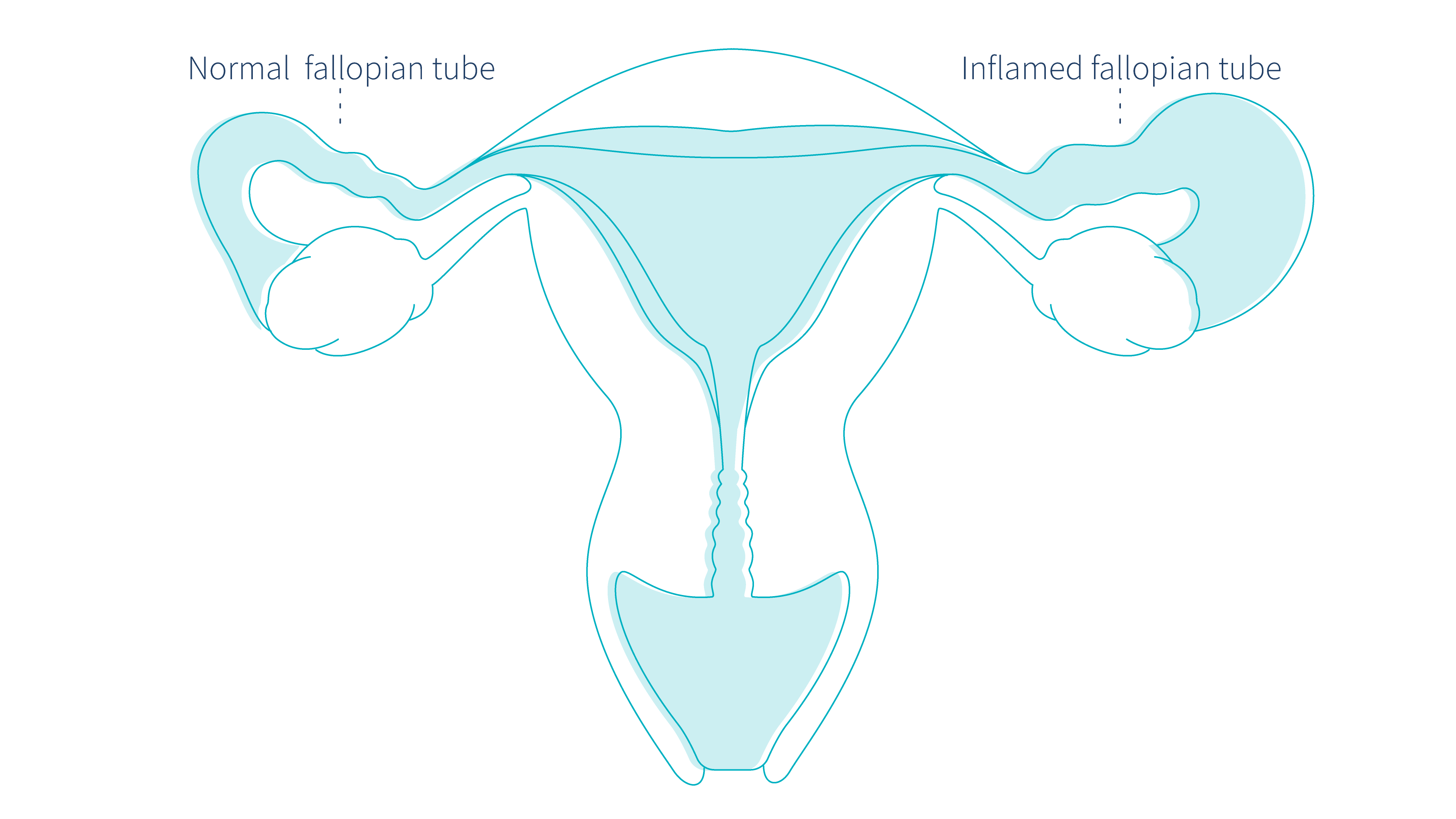 pelvic-inflammatory-disease-possible-cause-of-yellow-vaginal-discharge