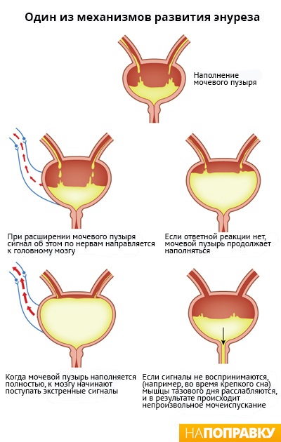 Схема развития недержания мочи