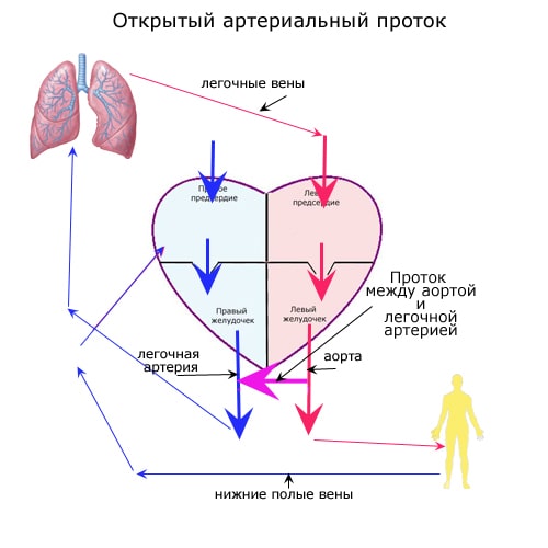 Открытый аортальный проток схема