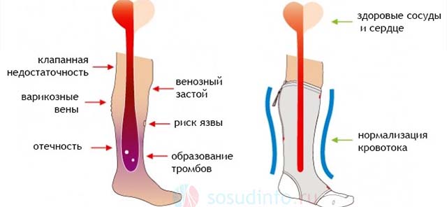 Компрессионные чулки