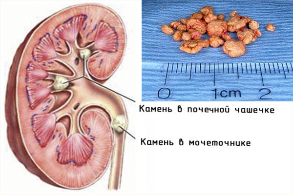 Мочекаменная болезнь