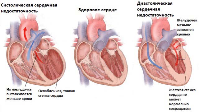 Сердечная недостаточность