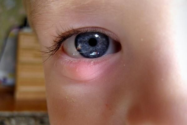 Халязион на глазу у ребенка