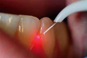 Почему в дырке или между зубами выросла десна что делать и как это лечить?