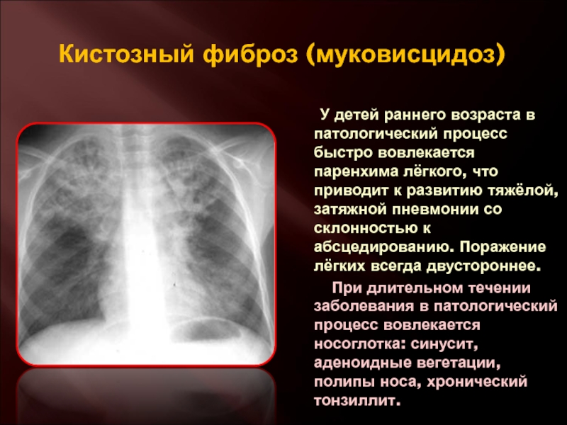 Фиброз легких врач. Муковисцидоз легочная форма у детей рентген. Муковисцидоз бронхолегочная форма. Фиброз легочной ткани на рентгене. Что такое кистозный фиброз лёгких.