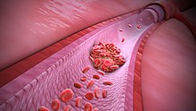 3D Medical animation still explaining the Thrombophilia