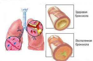 Поражение бронхиол