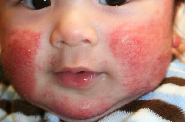 Аллергическая сыпь на лекарства у ребенка фото