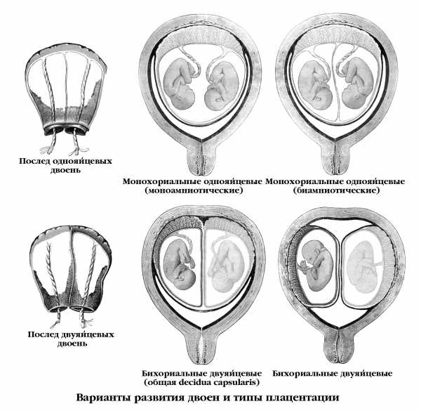 Фото монохориальная диамниотическая двойня